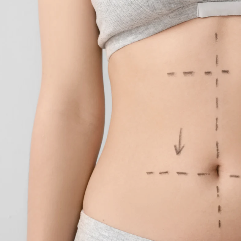Free Liposuction Consultations in Arlington VA